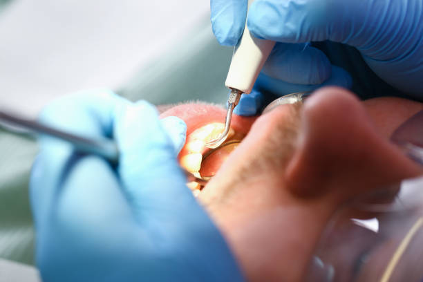 Best Broken or Cracked Tooth Emergency Dentist in Flanders, NY